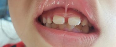 Cắt thắng lưỡi có gây đau không?