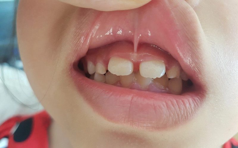Cắt thắng lưỡi có gây đau không?