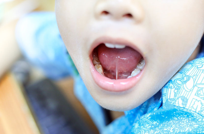 Khái niệm về dính thắng lưỡi?