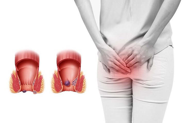 Laser điều trị trĩ tại Quy Nhơn