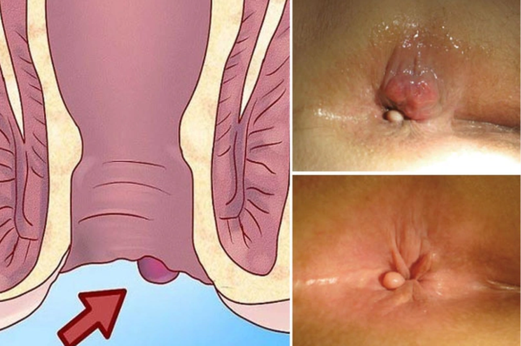 Laser điều trị trĩ tại Quy Nhơn
